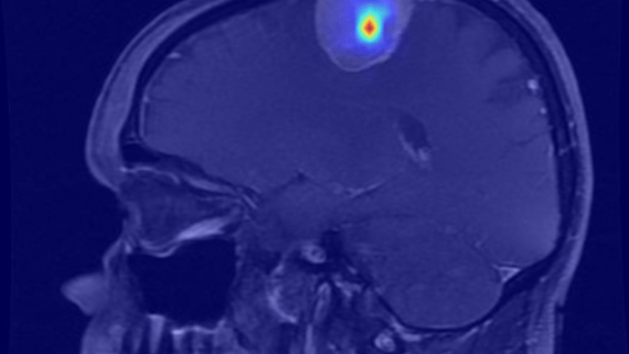 Scan met een tumor in de schedel 