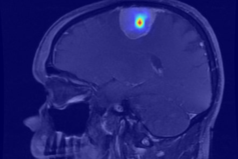 Scan met een tumor in de schedel